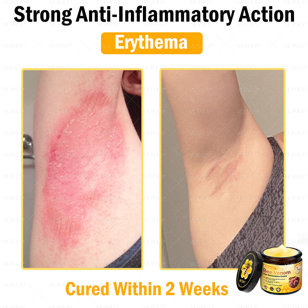 VLSVLS® Bee Venom Skin Restoration Cream (Suitable for use byindividuals of all ages & AAD recommends)✅