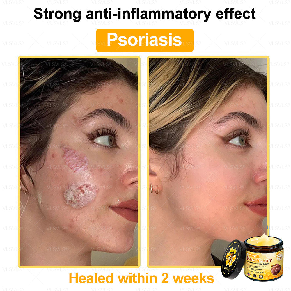 VLSVLS® Bee Venom Skin Restoration Cream (Suitable for use byindividuals of all ages & AAD recommends)✅