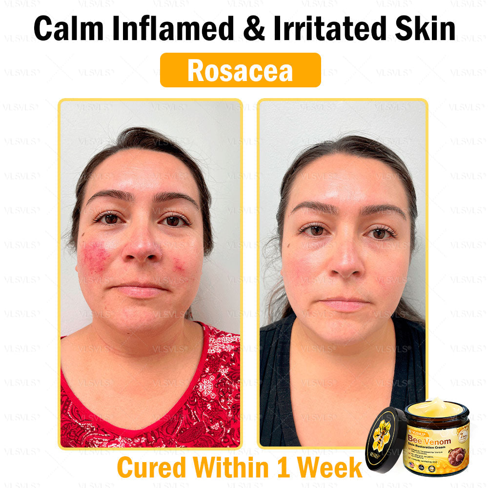 VLSVLS® Bee Venom Skin Restoration Cream (Suitable for use byindividuals of all ages & AAD recommends)✅