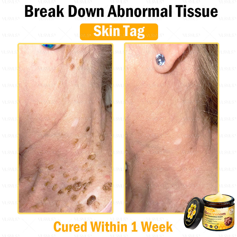 VLSVLS® Bee Venom Skin Restoration Cream (Suitable for use byindividuals of all ages & AAD recommends)✅