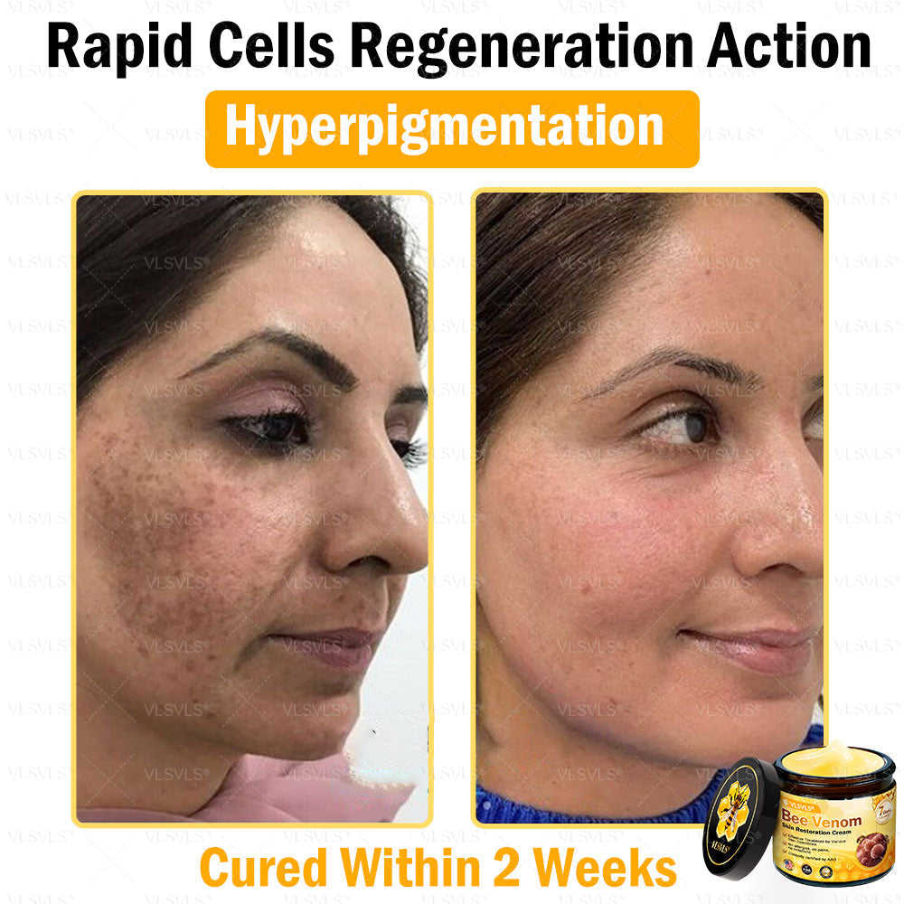 VLSVLS® Bee Venom Skin Restoration Cream (Suitable for use byindividuals of all ages & AAD recommends)✅