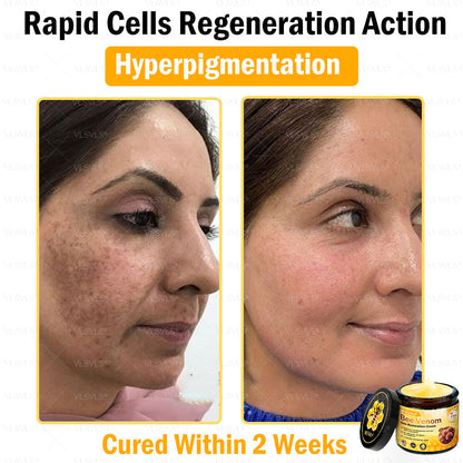VLSVLS® Bee Venom Skin Restoration Cream (Suitable for use byindividuals of all ages & AAD recommends)✅